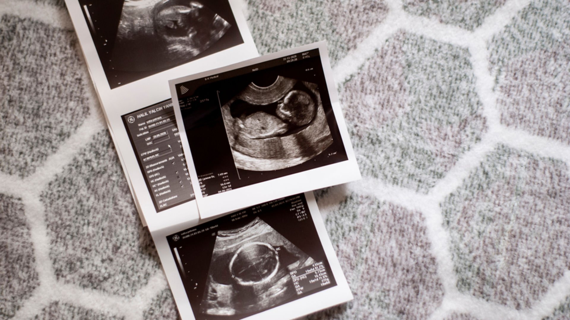 Ultrason terimleri ve anlamları